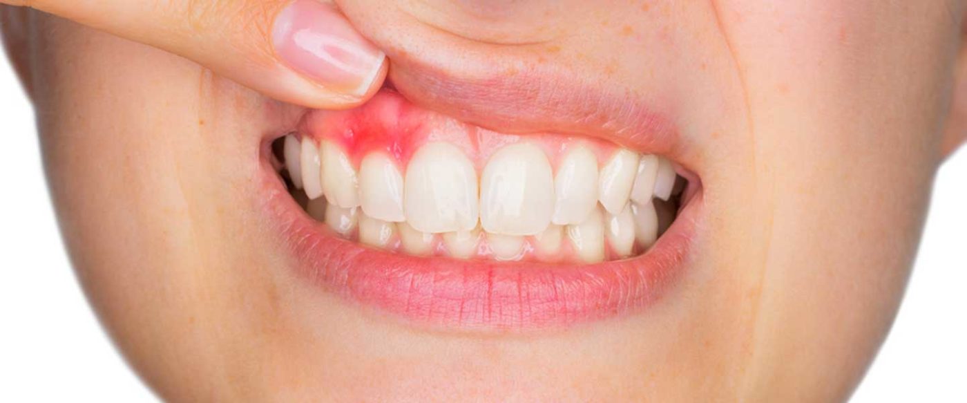 Özel Park Ağız ve Diş Sağlığı Polikliniği Kuşadası Diş Eti Rahatsızlıkları Tedavisi